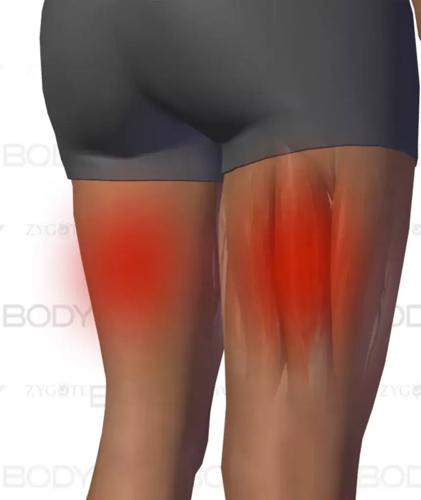 hamstring